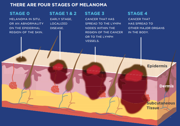 Melanoma Staging