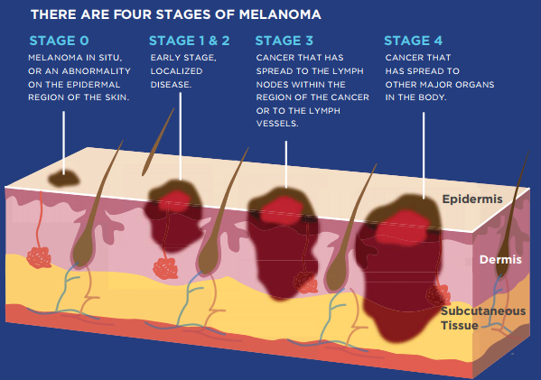 Staging Of Melanoma Photos And Vectors