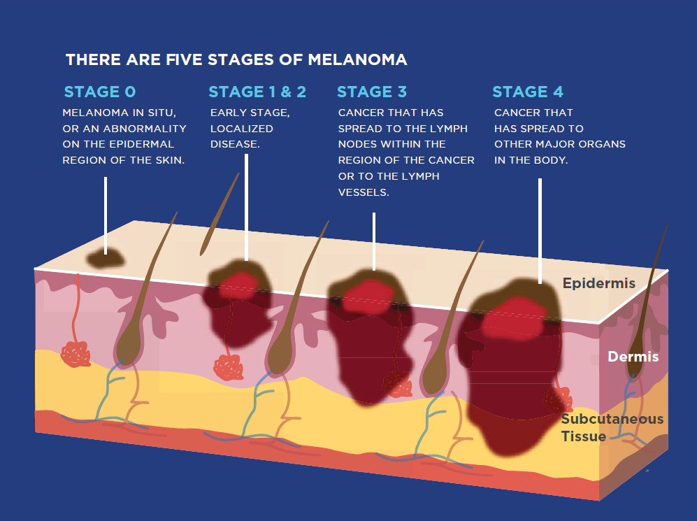 Melanoma Diagram